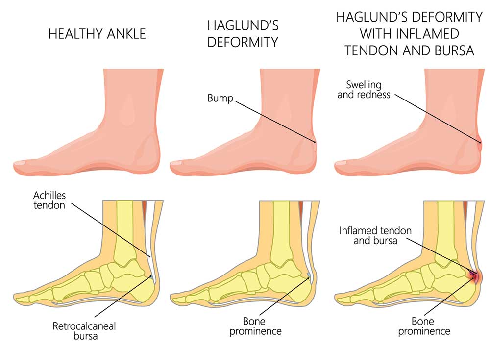 Haglunds Deformity