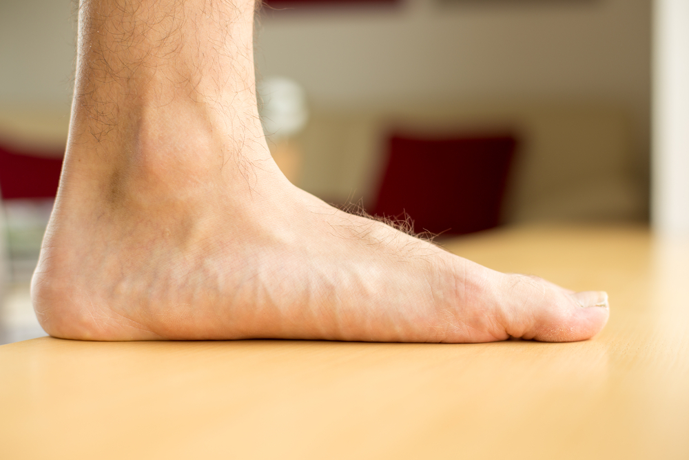 Santa Monica Flat Feet Treatment | SoCal Sports Podiatry