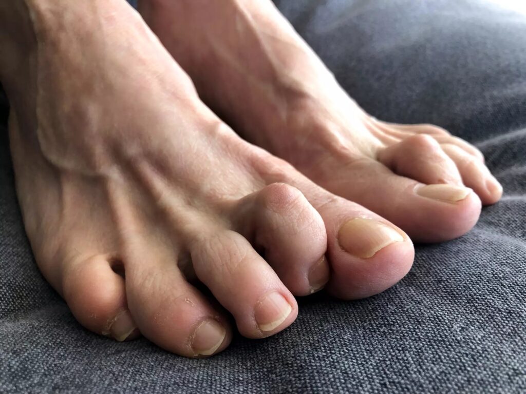 hammertoes