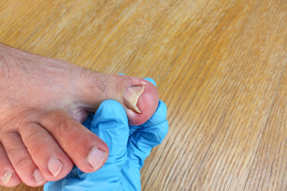 ingrown toenail foot doctor examines