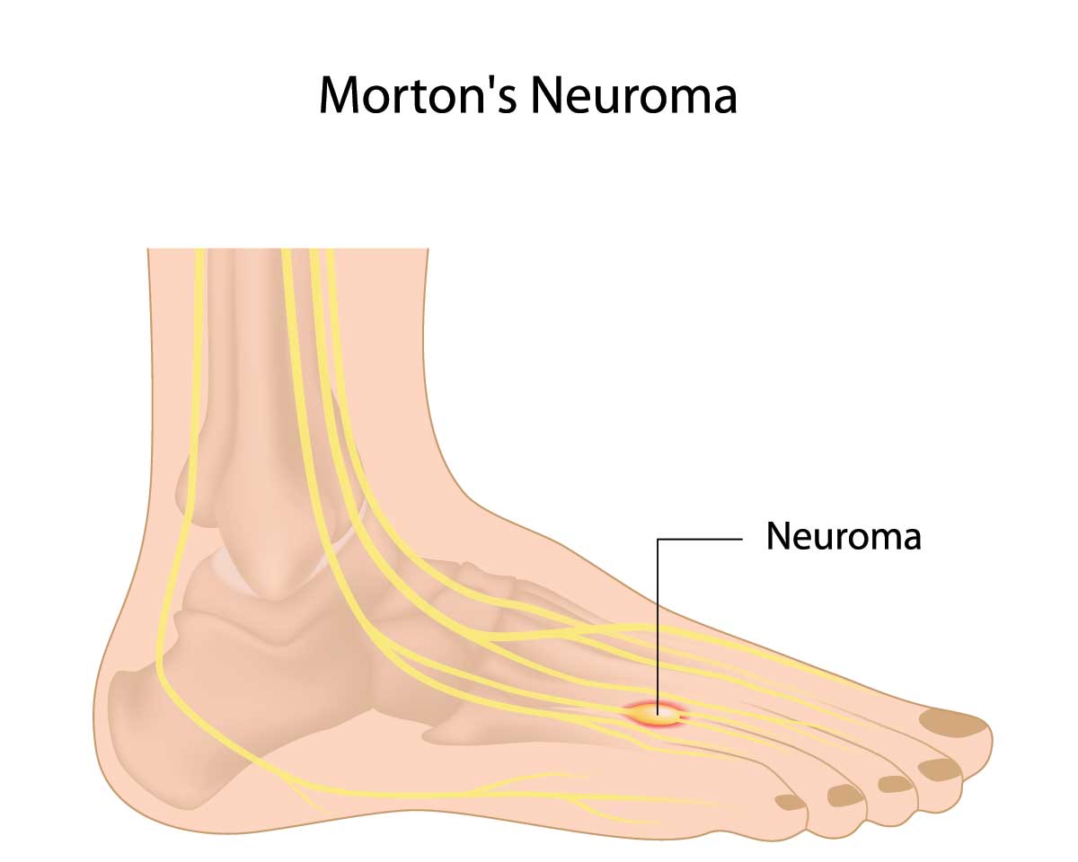 mortons neuroma